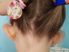 Отопластика Отопластика