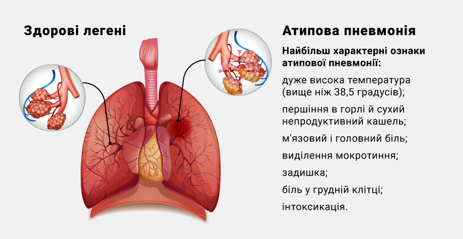 Атипичная пневмония