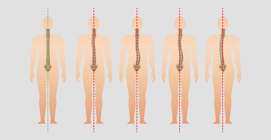 Искривление позвоночника