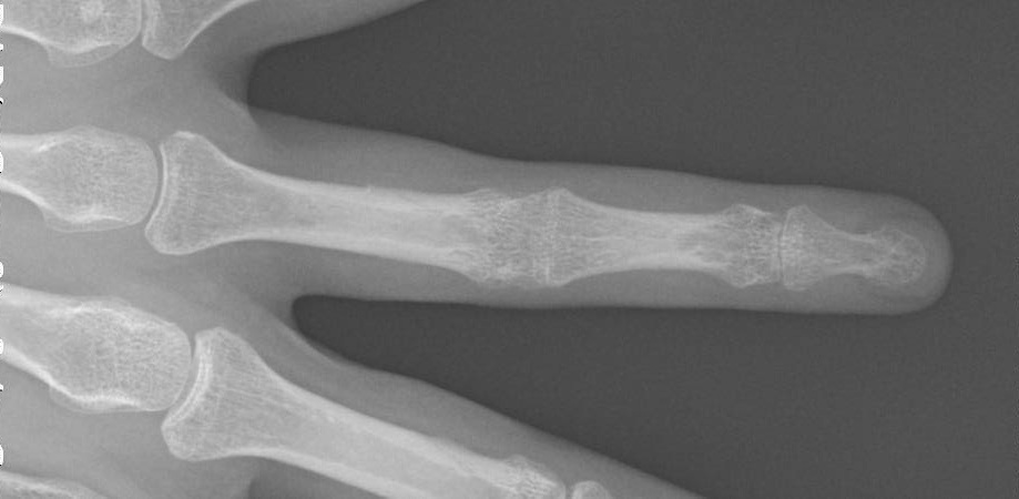 травма пальця