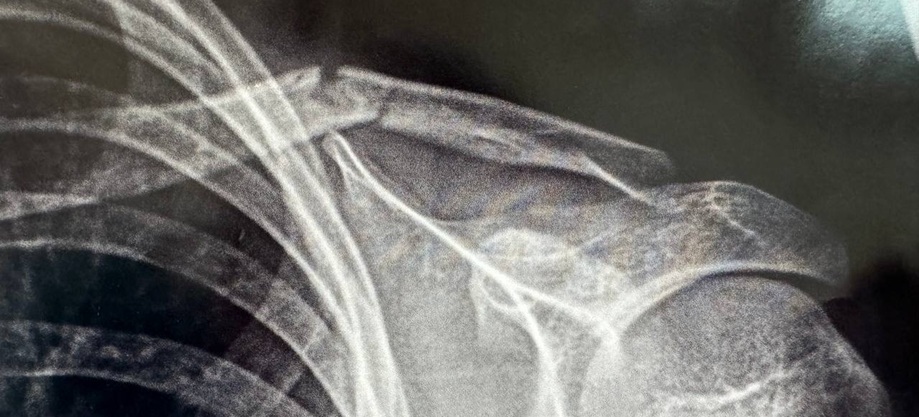 перелом ключицы