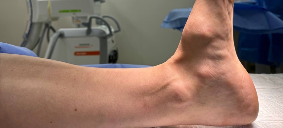 новообразование стопа