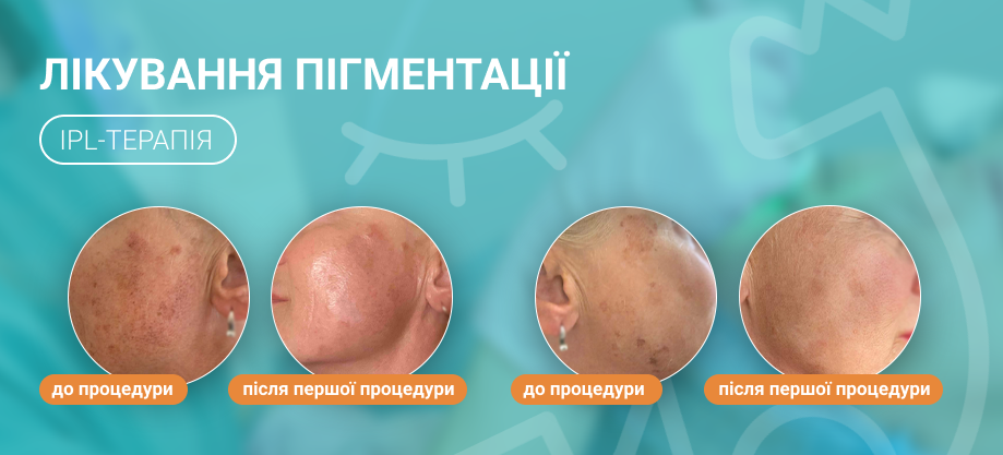 лікування пігментації лечение пигментации