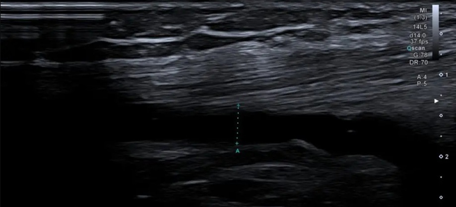 УЗИ коленного сустава