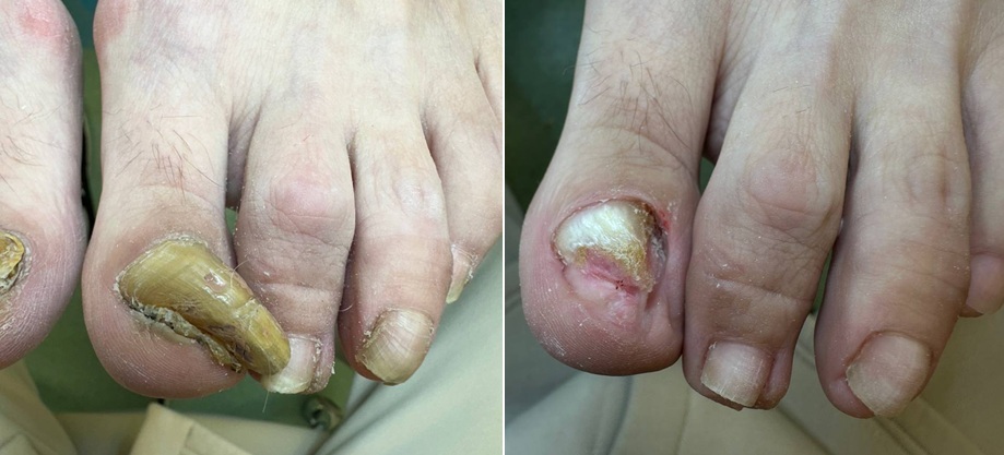 Онихогрифоз