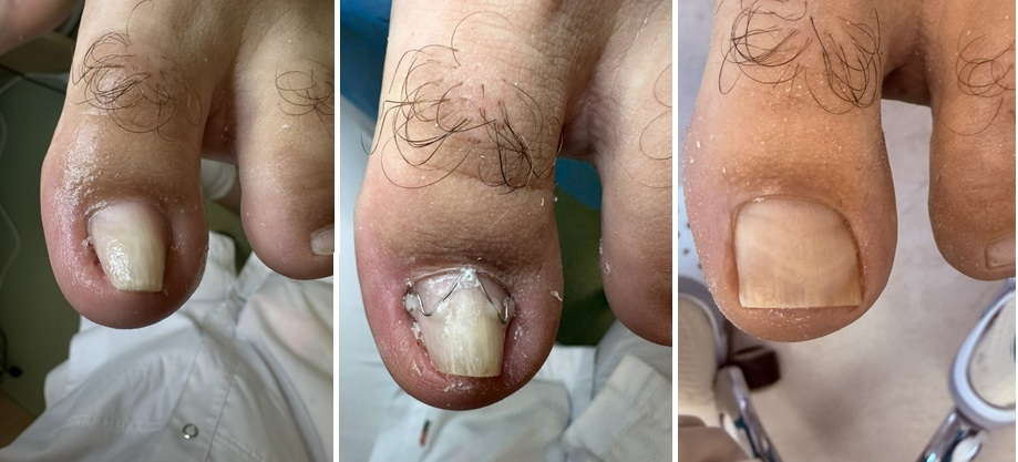 коррекция деформированного ногтя