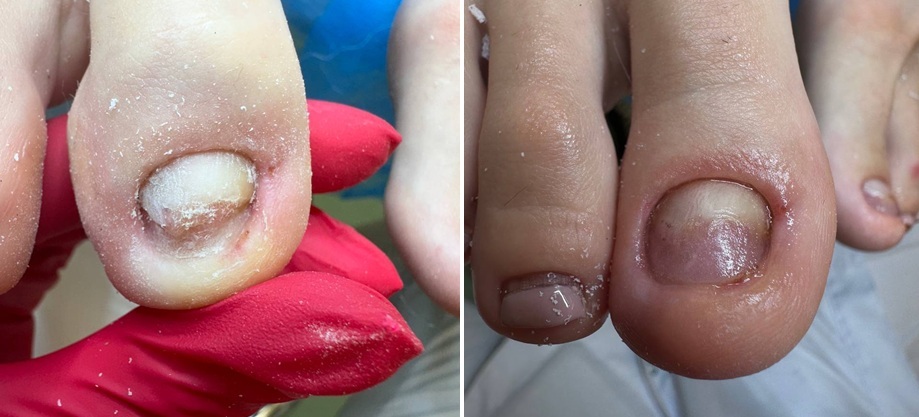 протез ногтевой пластины