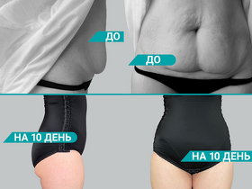 Абдомінопластика (пластика живота)