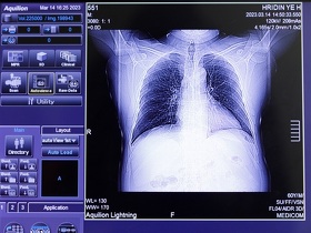 Атипичная пневмония. Лечение