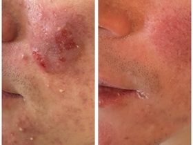 Кейс: лечение гнойного воспаления кожи у пациента с хроническим течением