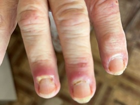 Кейс: диагностика аутоимунного заболевания дерматологом