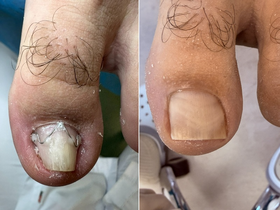 Кейс: коррекция деформированного ногтя