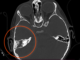 Кейс: лечение врождённой холестеатомы у ребёнка