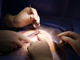 Секторальна резекція молочної залози Секторальная резекция молочной железы