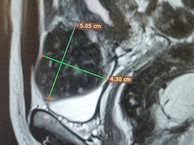 Клінічний кейс: леймоміома