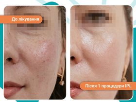 Кейс: лечение купероза IPL-терапия