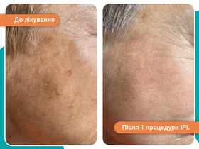 Кейс: лечение пигментации IPL-терапия 