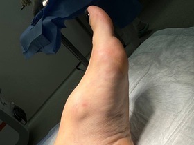 Кейс: образование на тыльной поверхности стопы