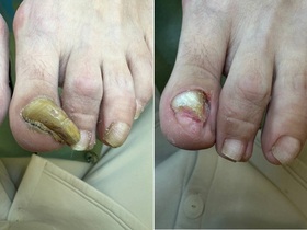Кейс: выраженный онихогрифоз у маломобильной пациентки