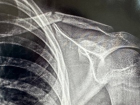 Кейс: перелом ключицы