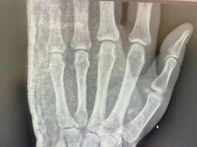 Кейс: перелом кисті