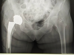 Кейс: перелом шейки бедренной кости