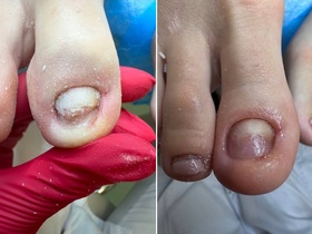 Кейс: протезирование ногтевой пластины