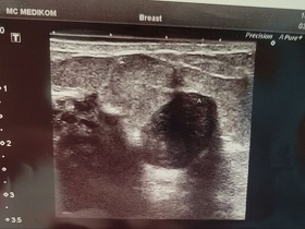 Кейс: Секторальная резекция, фиброаденома