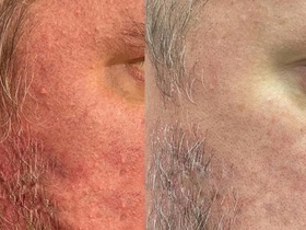 Кейс: лечение розацеа у мужчины	