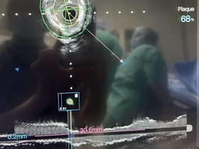 Кейс: стентирование огибающей артерии