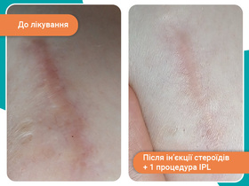Кейс: безоперационное лечение рубцов	
