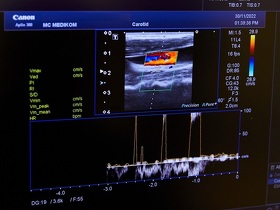 Доплерографія судин голови та шиї 