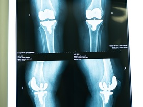 Эндопротезирование коленного сустава