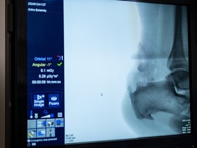 Хірургічне лікування хвороби Хаглунда	