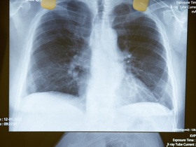 Хроническая обструктивная болезнь легких