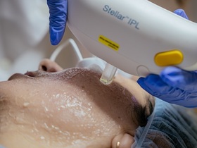 Лечение пигментации (IPL терапия) в Киеве