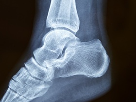 Як позбутися деформації Хаглунда? ак избавиться от деформации Хаглунда?