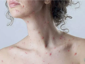 Лечение ветряной оспы