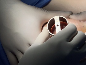 Корекція соска та ареоли