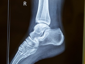 КТ голеностопного сустава