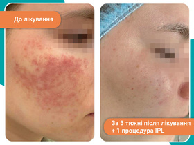 Лечение акне/розацеа (IPL терапия) в Киеве