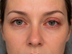 Лечение блефарита в Киеве