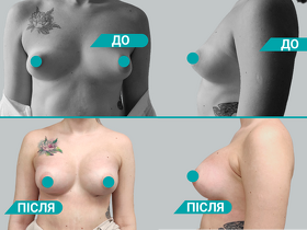 Мамопластика