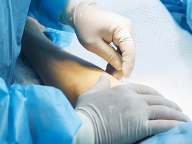 Склеротерапія вен