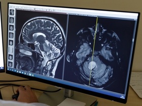 МРТ гіпофіза