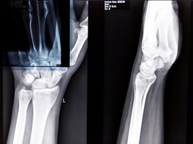 МРТ променево-зап'ястного суглоба та зап'ястя МРТ лучезапястного сустава и запястья