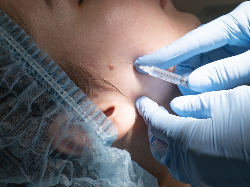 P1049212.jpg видалення родимки без болю