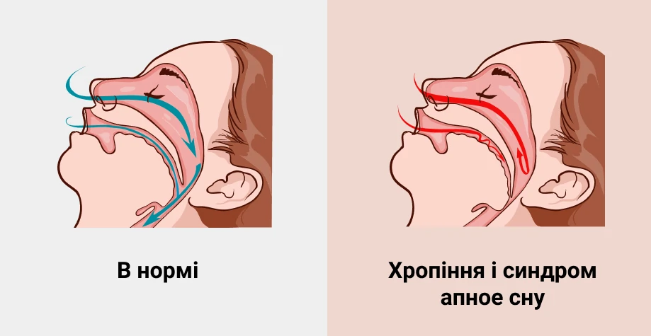 Причины храпа