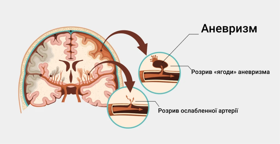 Аневризма