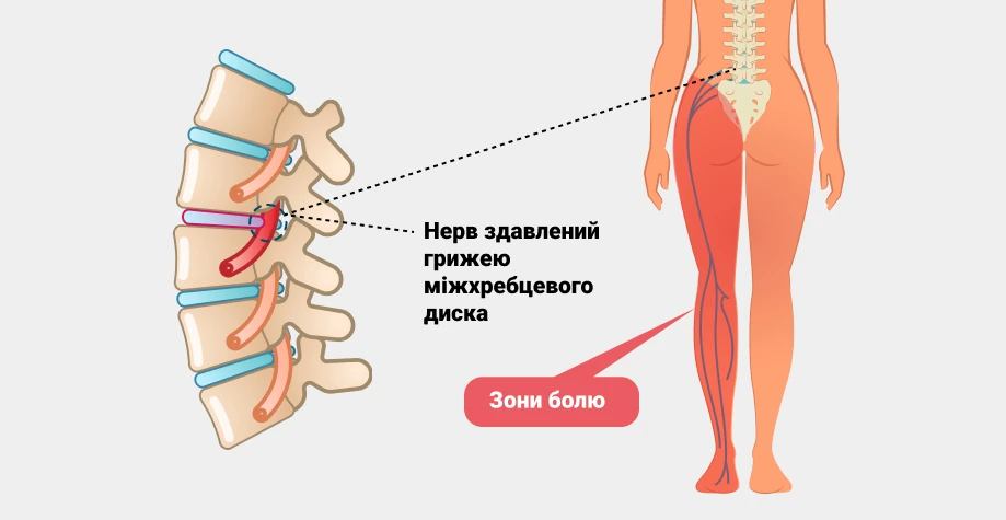 Ишиалгия седалищного нерва
